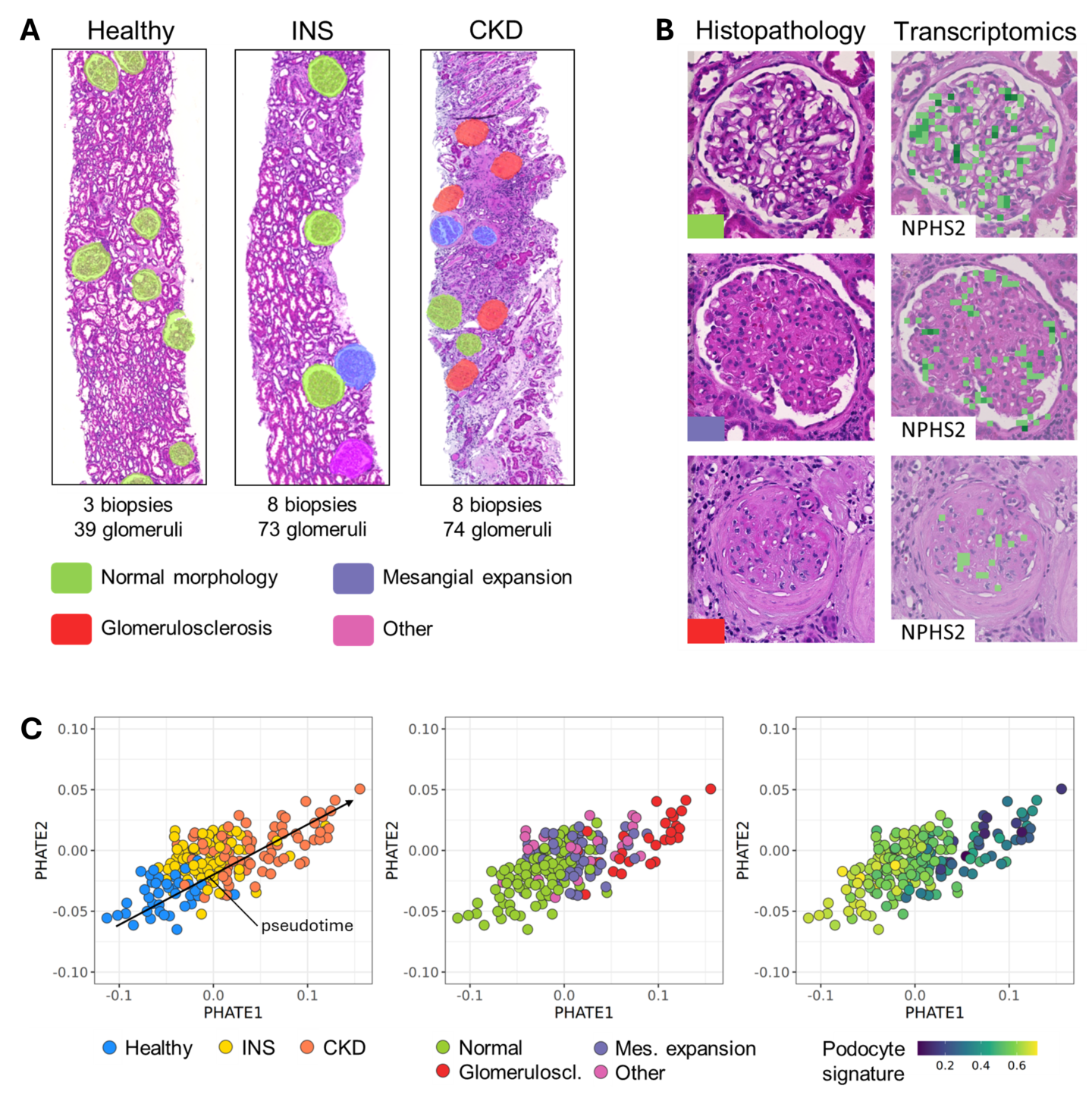 A multi-panel figure showing kidney tissue sections with color-coded glomeruli highlighting disease progression, paired H&E and NPHS2-stained glomerulus images from healthy to sclerotic, and PHATE dimensionality reduction plots illustrating pseudotime trajectory and declining podocyte gene signature scores across disease stages.