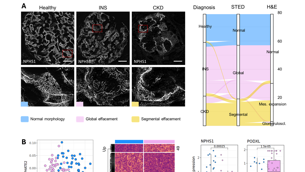 Multi-panel figure showing podocyte foot process morphology via NPHS1-stained STED microscopy across healthy, INS, and CKD kidney tissue, alongside a Sankey diagram mapping diagnosis to glomerular pathology categories, and supporting PHATE plots and gene expression data for NPHS1 and PODXL markers.