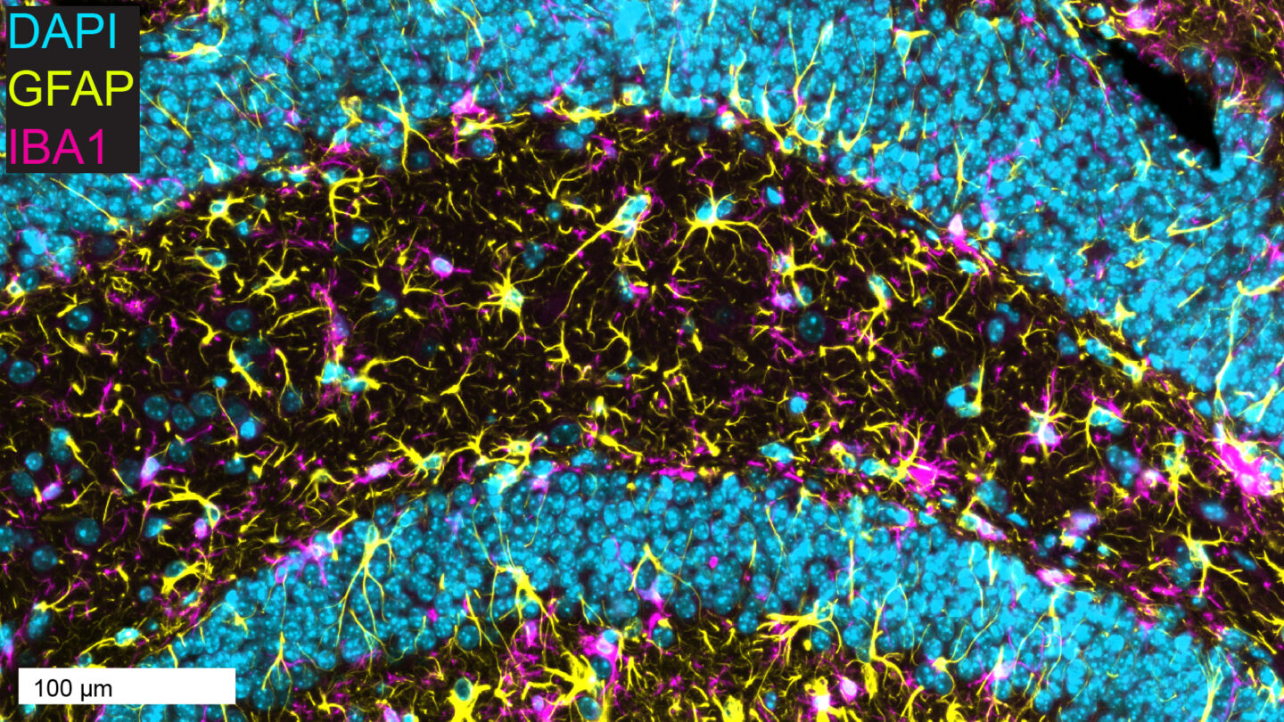 Fluorescence microscopy image of brain tissue showing triple immunostaining with three markers: DAPI (cyan) staining cell nuclei, GFAP (yellow) marking astrocytes with their characteristic star-shaped morphology and processes, and IBA1 (magenta) labeling microglial cells. The image shows a dense band of GFAP-positive astrocytes forming a dark curved region across the center, surrounded by DAPI-labeled nuclei in the upper and lower portions. Scale bar indicates 100 micrometers.